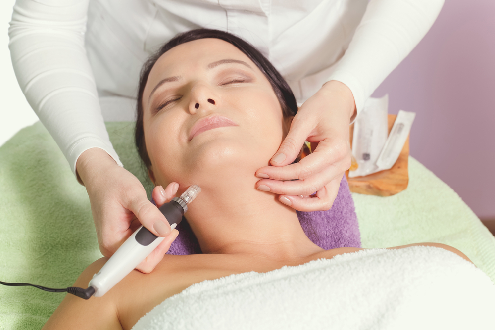 microneedling